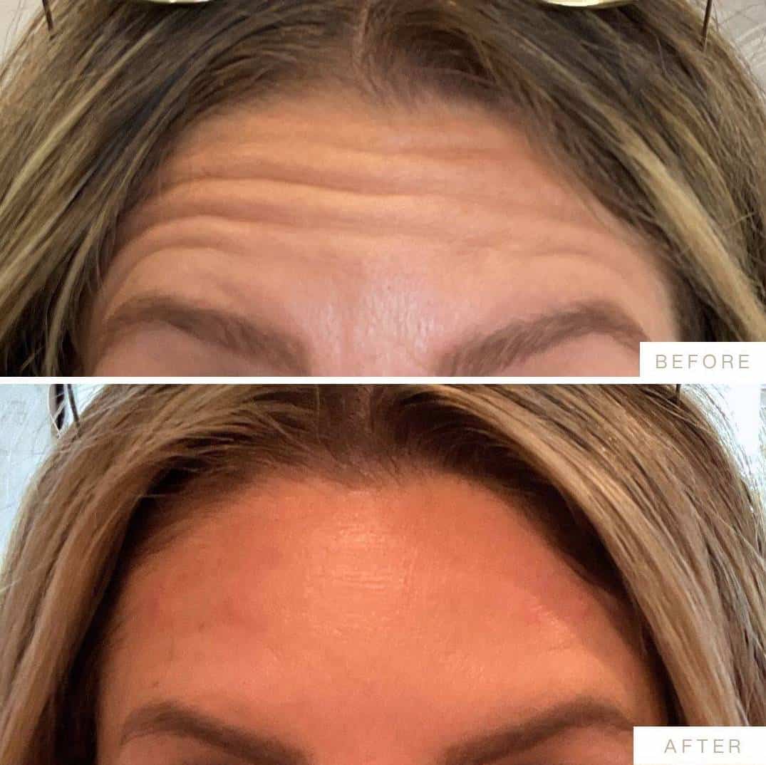 botox-forehead-before-after-lake-country