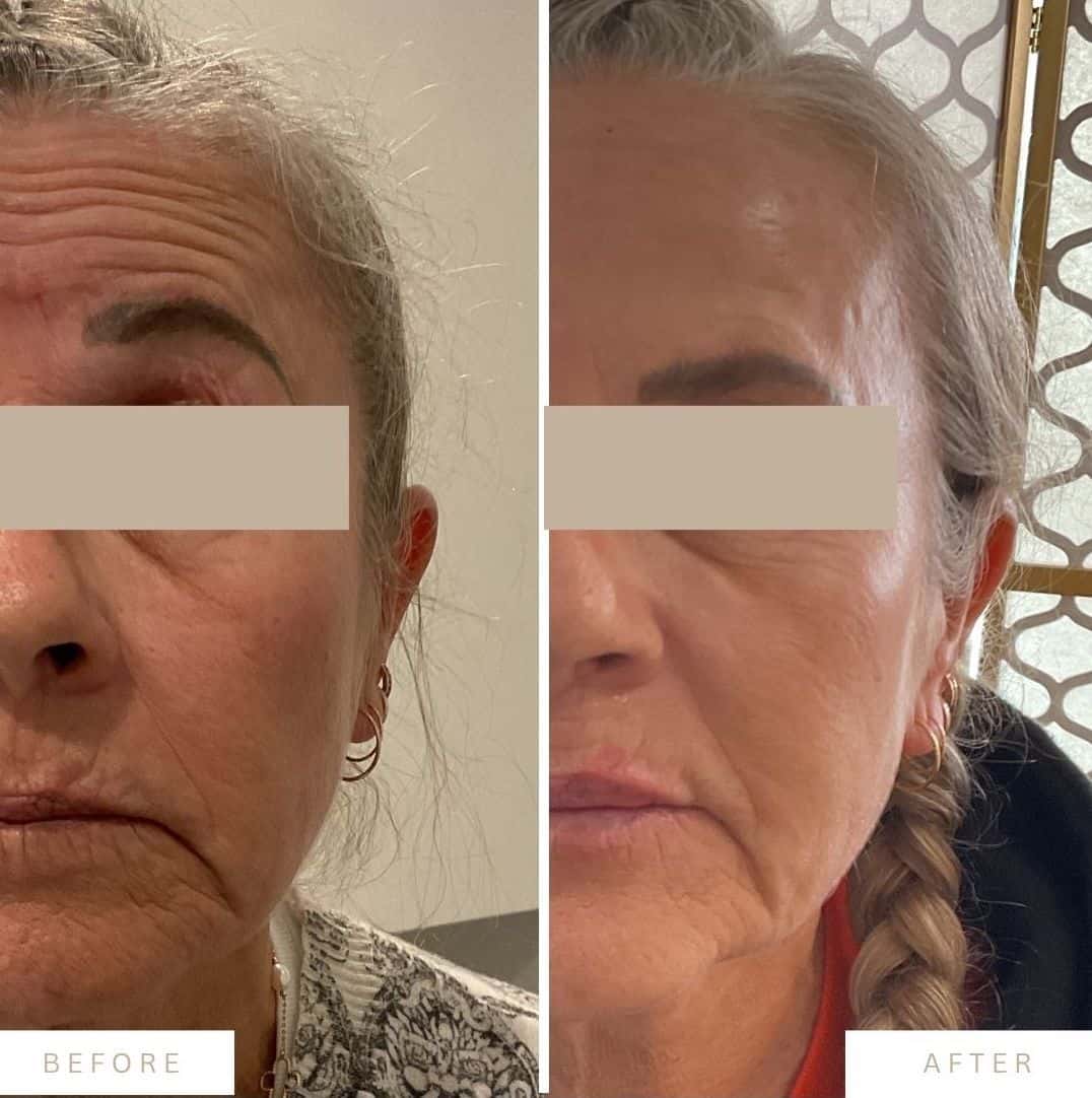 transformation-botox-filler-kamloops