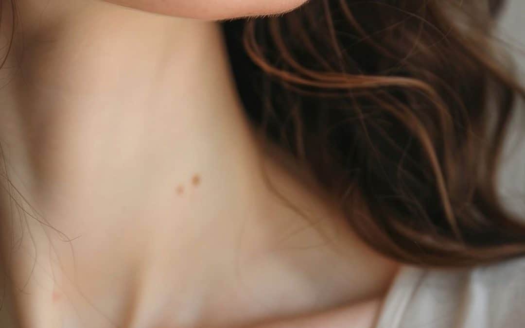 Close-up of a woman’s neck for a blog about hypothyroidism, thyroiditis, and fertility support in BC.