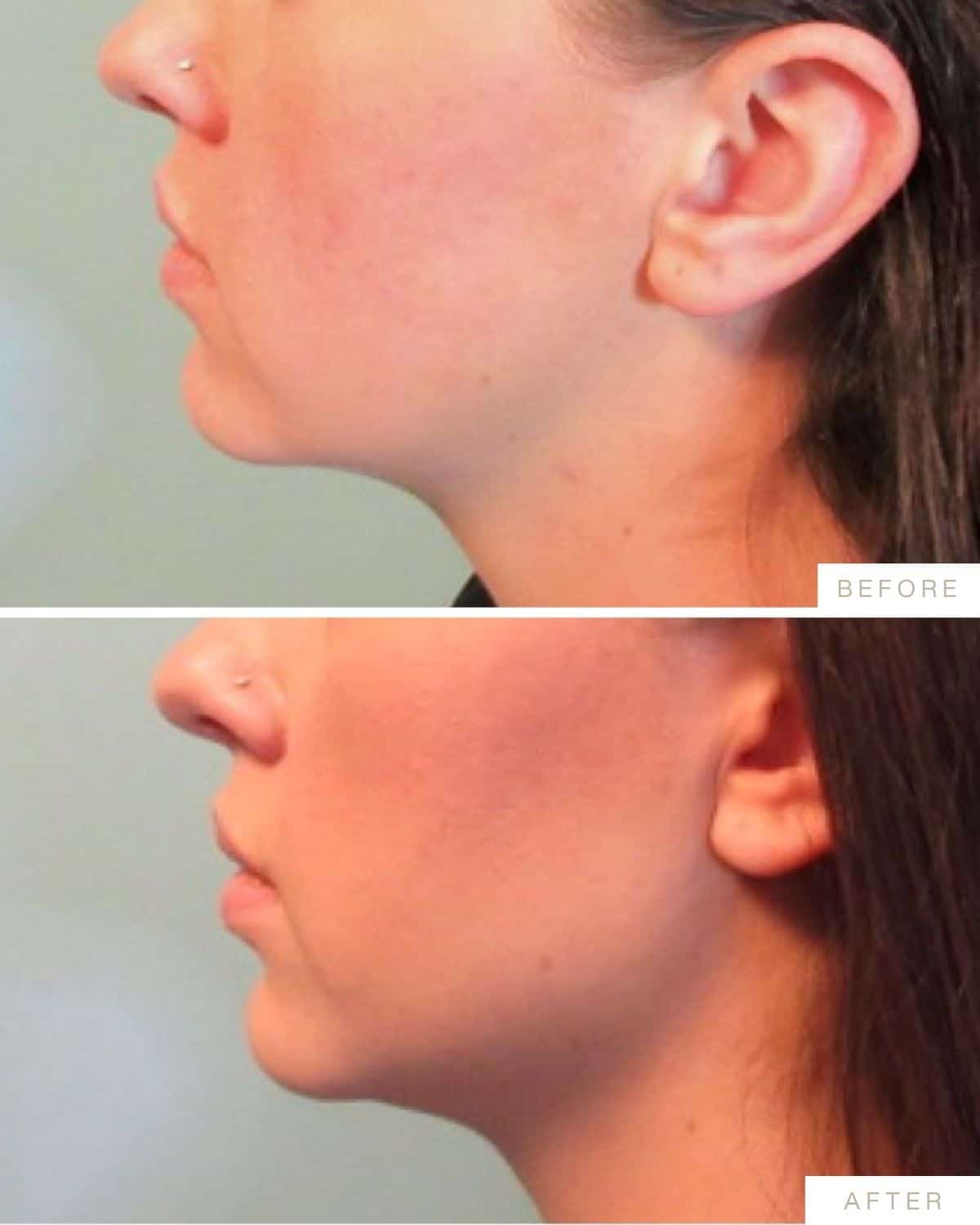 Patient before and after photographs shared by Dr. Marissa Gaucher, 2026-07-13