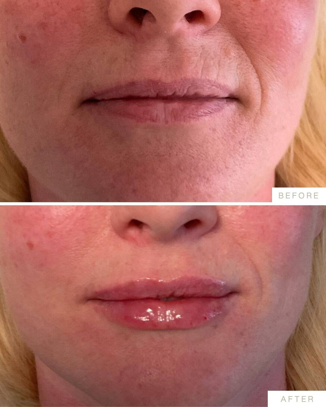 Patient before and after photographs shared by Dr. Marissa Gaucher, 2026-08-10