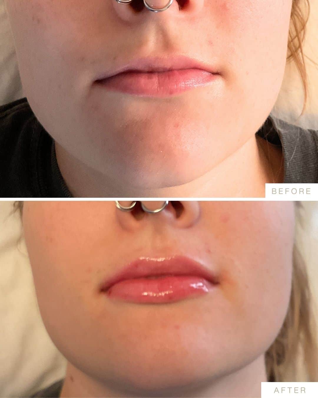 Patient before and after photographs shared by Dr. Marissa Gaucher, 2026-09-16